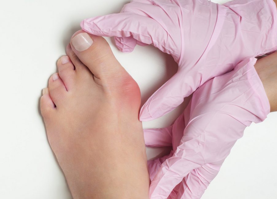 Stepping Towards Pain Free Walking: 4 Signs You Need Bunion Surgery