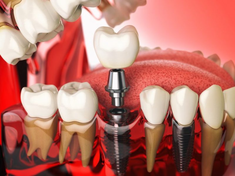 How Much Do Full Upper and Lower Dental Implants Cost