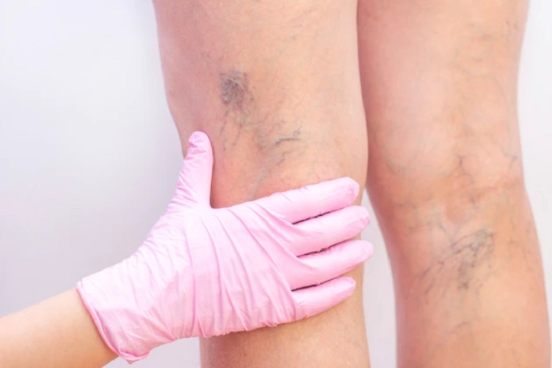 female leg varicose veins