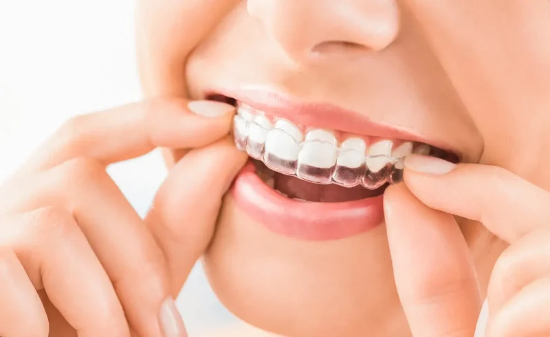 Invisalign and its Effectiveness in Las Vegas