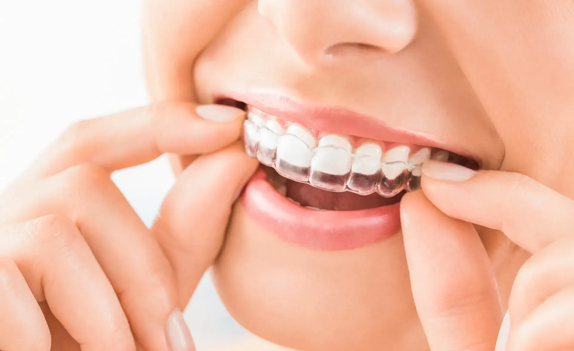 Invisalign and Its Effectiveness in Las Veg￼as