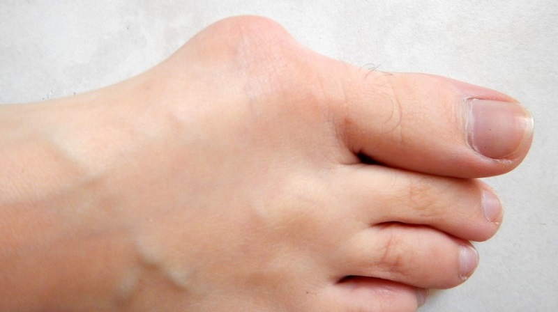 bunion-foot